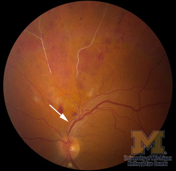 Copper-Wiring and Silver-Wiring : Ophthalmoscopic Abnormalities : The