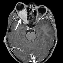 Neurofibromatosis Type I : Systemic Conditions : The Eyes Have It