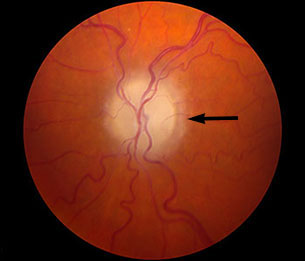 Papilledema : Ophthalmoscopic Abnormalities : The Eyes Have It