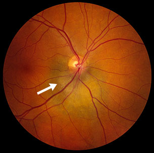 Choroidal Melanoma : Other Eye Conditions : The Eyes Have It