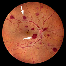 Leukemia : Systemic Conditions : The Eyes Have It