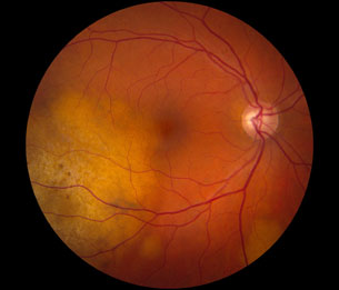 Subretinal Hemorrhage : Ophthalmoscopic Abnormalities : The Eyes Have It