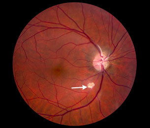 Tuberous Sclerosis Complex : Systemic Conditions : The Eyes Have It