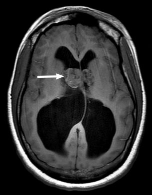 Tuberous Sclerosis Complex : Systemic Conditions : The Eyes Have It